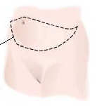 abdominoplasty incision