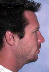 chin implant - after photo
