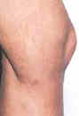sclerotherapy - after
