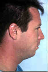 chin implants - before