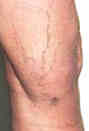 sclerotherapy - before photo