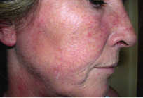 aesthera ppx before treatment