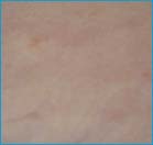 bikini line before tria laser hair removal