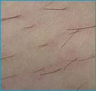 bikini line before tria laser hair removal
