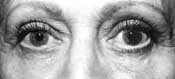 eyelid reduction and eyebag removal - after