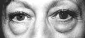 blepharoplasty - before