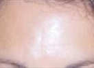 botox before photo of forehead