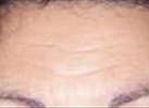 botox before - photo of forehead