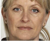 dermal filler restylane after injection