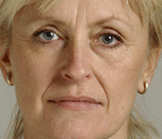 dermal filler restylane before injection