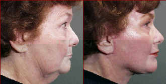 facelift before and after photo