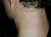 laser hair removal after