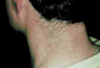 laser hair removal before
