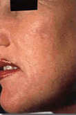 microdermabrasion after