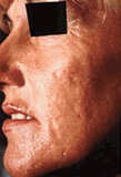 microdermabrasion before