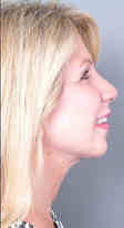 dermal filler restylane after injection