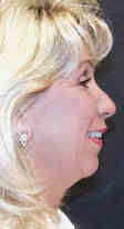 neck lift - before