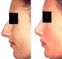 rhinoplasty (nose job) before and after photo
