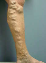 varicose veins